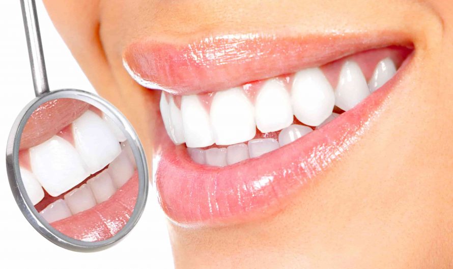 Quel blanchiment dentaire choisir?